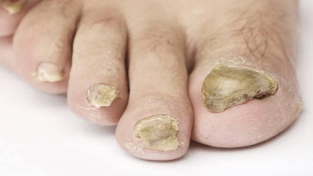 Tırnak mantarını kökünden temizliyor! Tamamen doğal çözüm