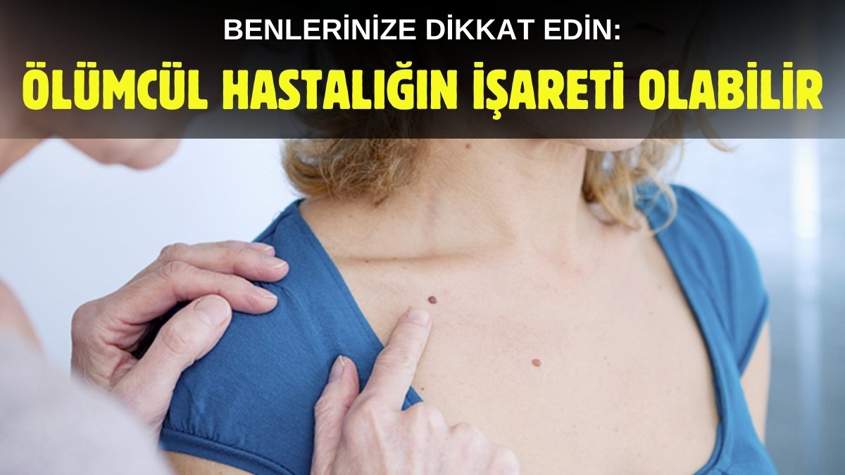 Beniniz bu şekildeyse ölümcül hastalığa yakalanmış olabilirsiniz: Hangi benler melanoma dönüşebilir?