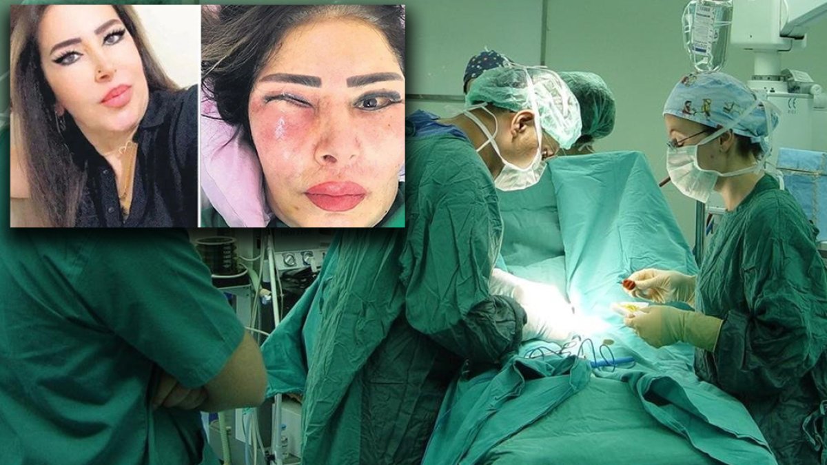 Yüz gerdirme ameliyatı hayatını kararttı: Gözünün içinde et çıktı