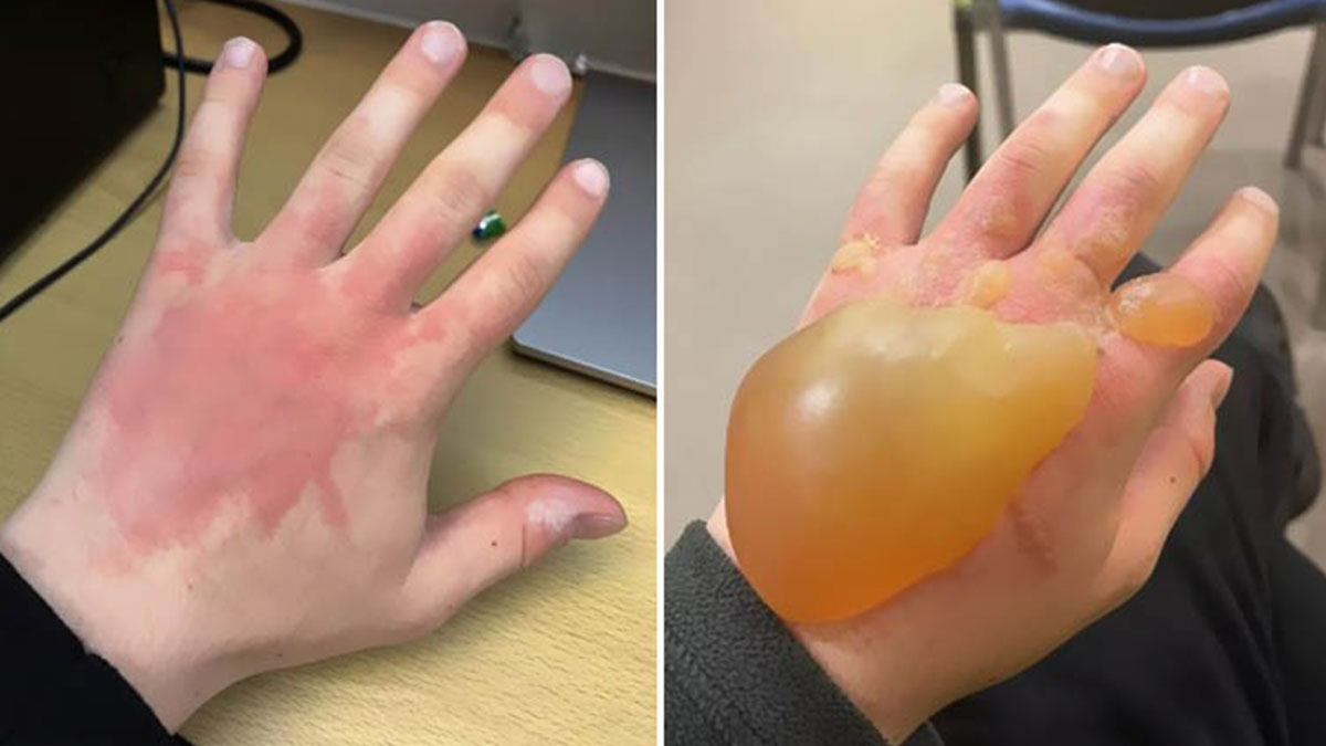 Dünyanın en tehlikeli bitkisi: Temas edenler korkunç acı çekiyor! Türkiye'de bu bölgelerde yaşayanlar dikkat etmeli