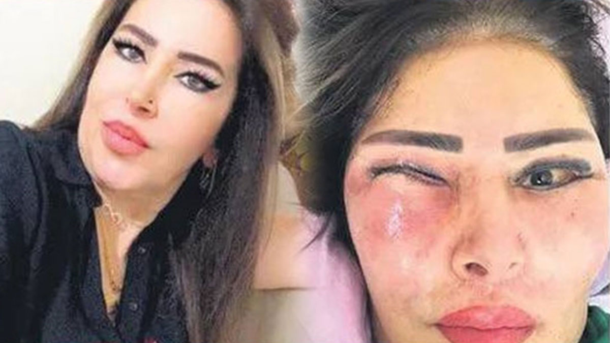 Yüz gerdirme ameliyatı oldu, gözünden et çıktı! Güzelleşmek isterken hayatı karardı