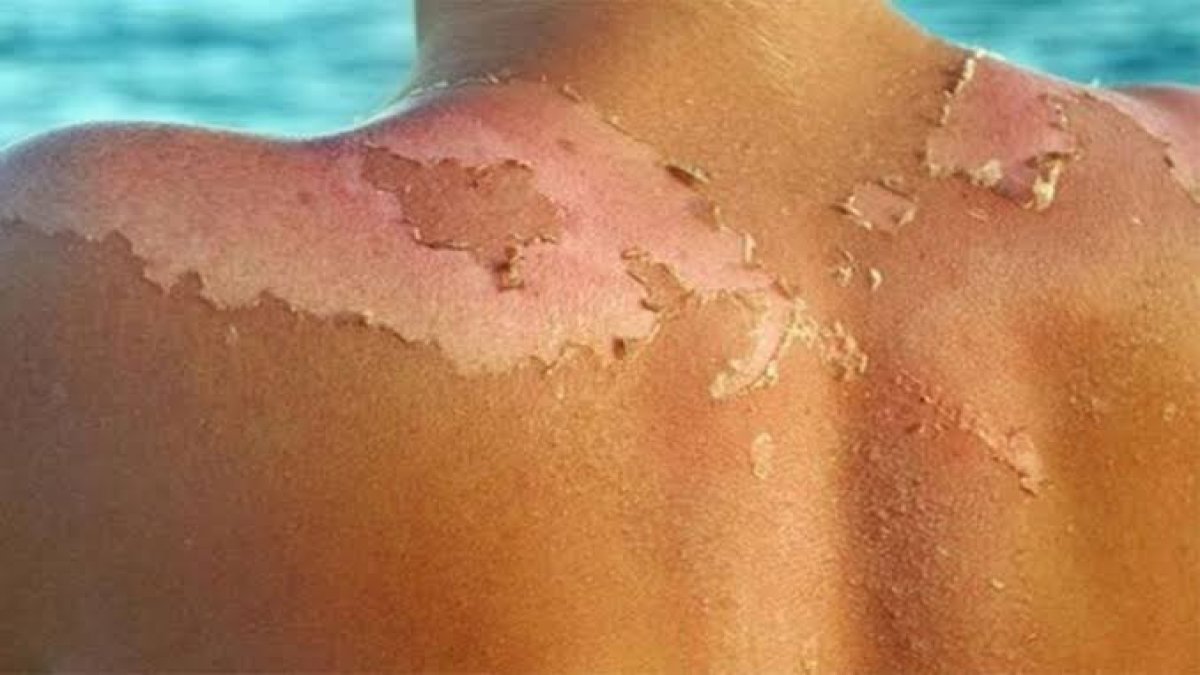 Güneş yanığına birebir: Yulaf ezmesi