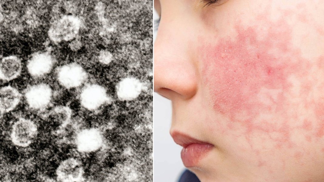 Yeni virüste korkutan artış: 5-9 yaş arasında hızla yayılıyor