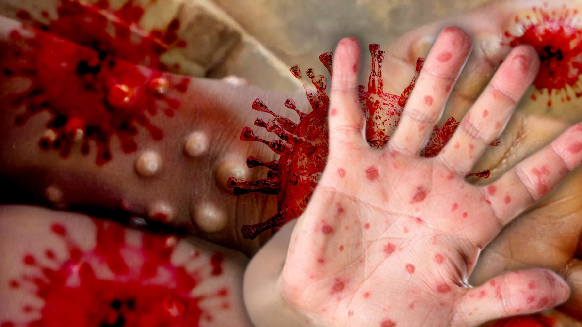 Muhalefet Afrika'dan gelecek binlerce öğrenciyi hatırlatarak sordu: Maymun çiçeğine karşı acil önlem çağrısı