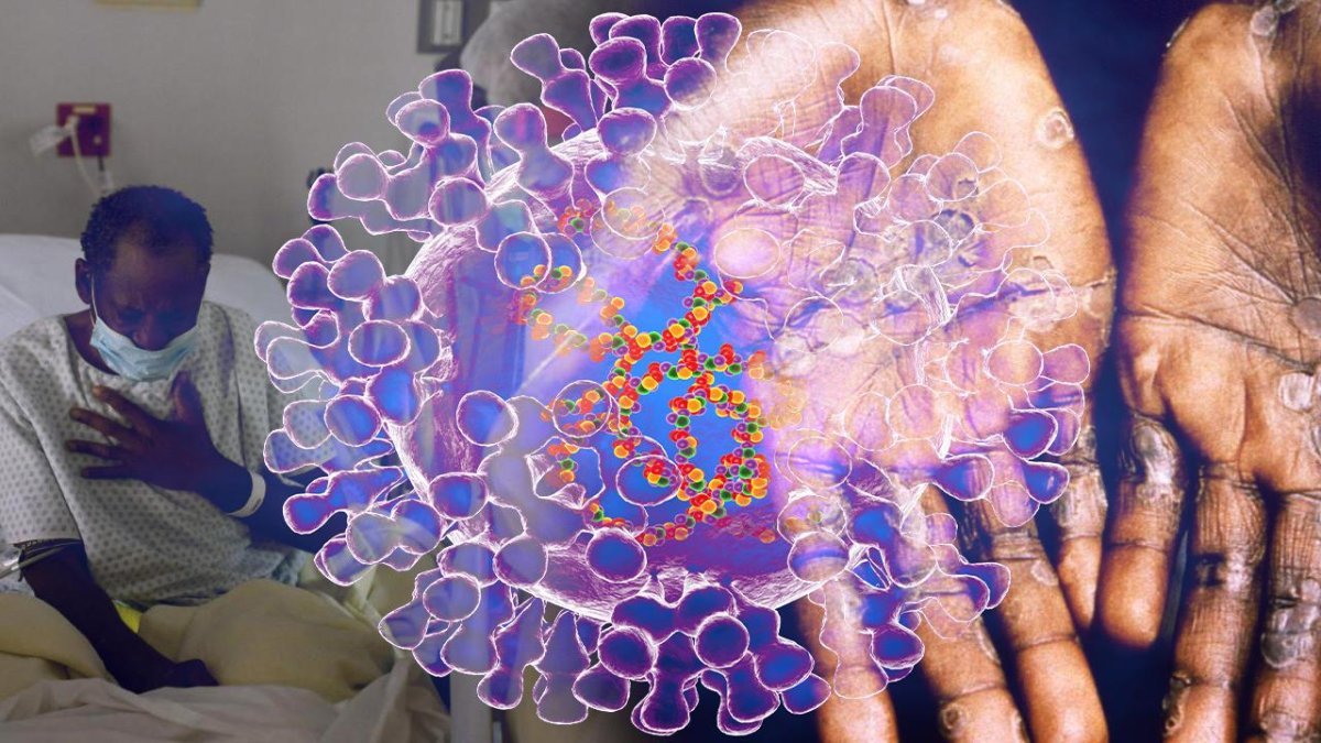 Sağlık Bakanlığı'ndan M çiçeği açıklaması: Türkiye'de kısıtlama olacak mı?