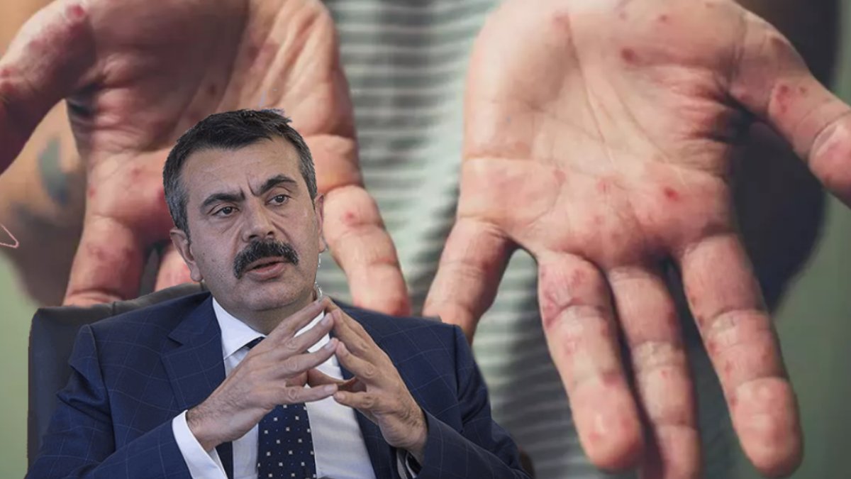 Binlerce Afrikalı öğrenci Türkiye'ye geliyor! Maymun çiçeği virüsü sonrası korkutan uyarı: Bakan Tekin açıkladı