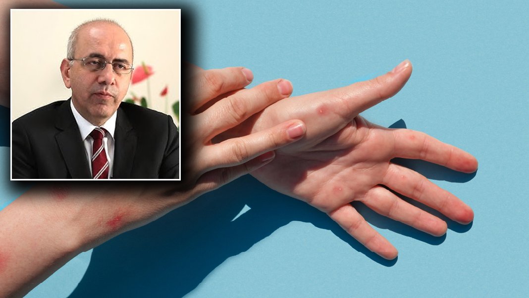 Bakanlık yalanlamıştı! Prof. Dr. Ergönül’den dikkat çeken açıklama: Maymun Çiçeği Türkiye’de görüldü