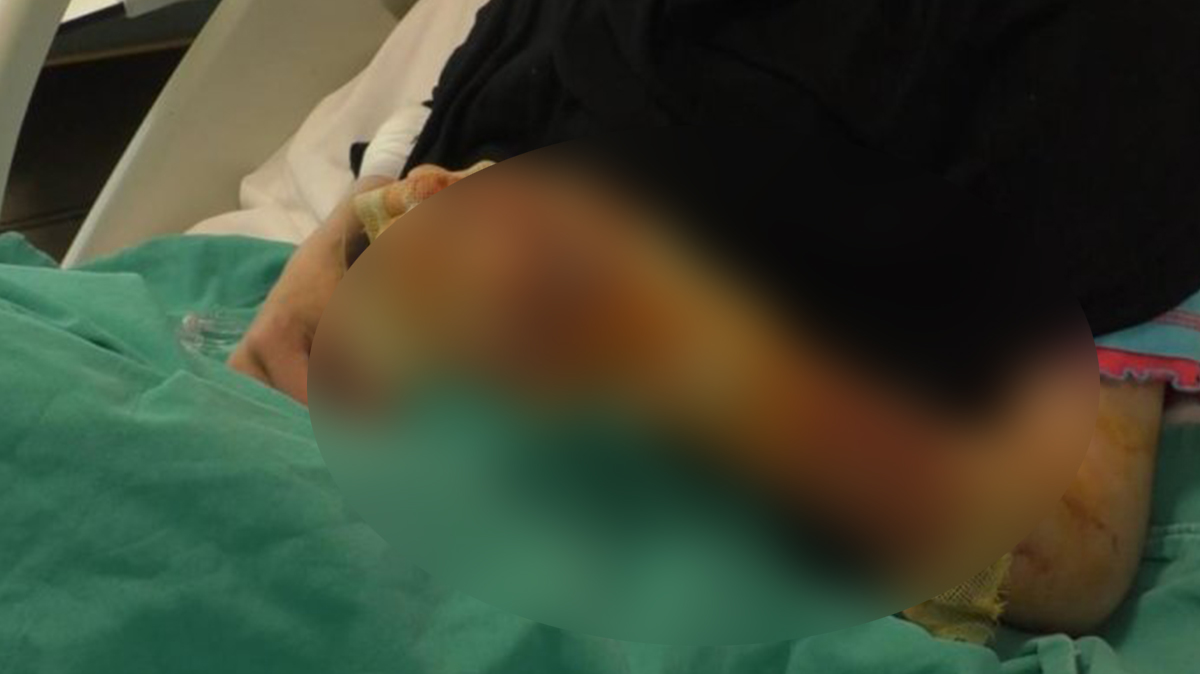 Mangal faciası! Vücudunun yüzde 40'ı yandı!