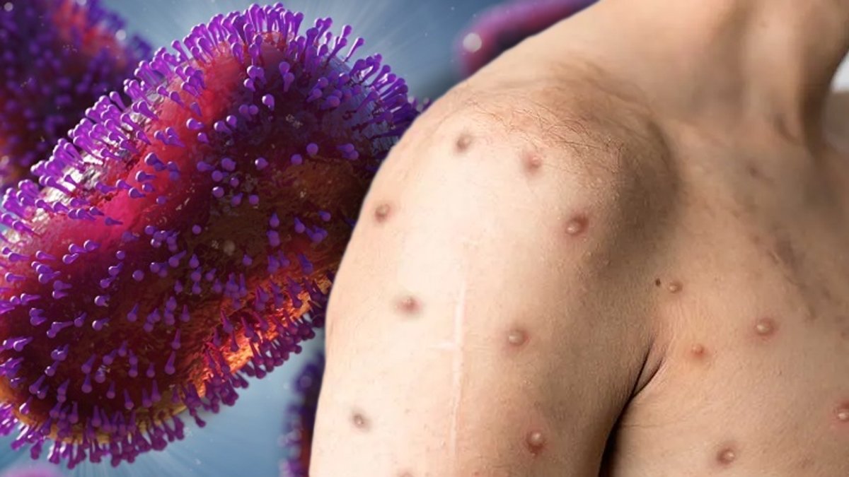 Maymun çiçeği virüsü için uzman uyarısı: Ateş, halsizlik ve baş ağrısı varsa...