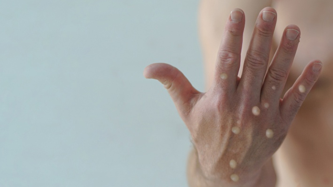 İsveç'in ardından bir ülkede daha Maymun Çiçeği görüldü