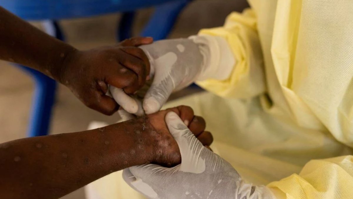 DSÖ'den maymun çiçeği çağrısı: Birlikte hareket etmeliyiz