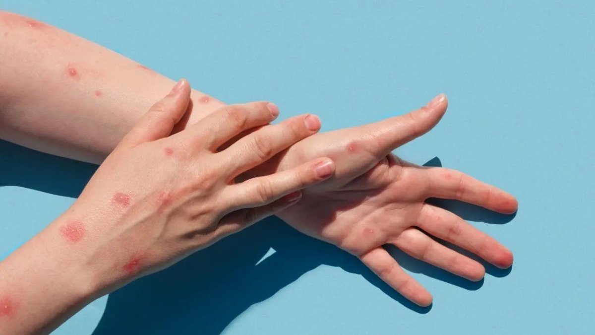 Prof. Dr. Tevfik Özlü açıkladı: Maymun çiçeği pandemisi mi geliyor?