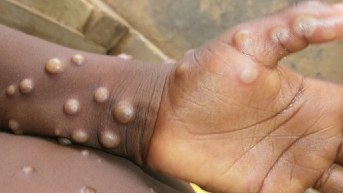 Kötü haber: Maymun çiçeği virüsü Afrika kıtasını aştı! İlk vaka doğrulandı