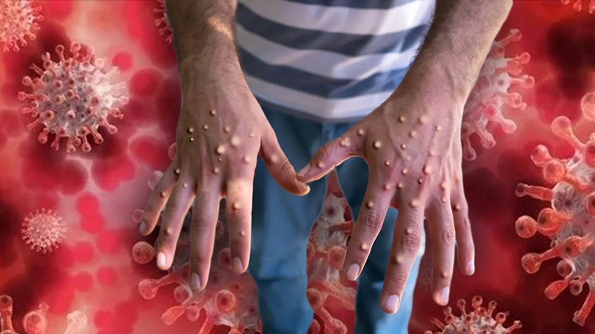 Turizm noktalarında 'maymun çiçeği' uyarısı: Enfekte alanlar olabilir