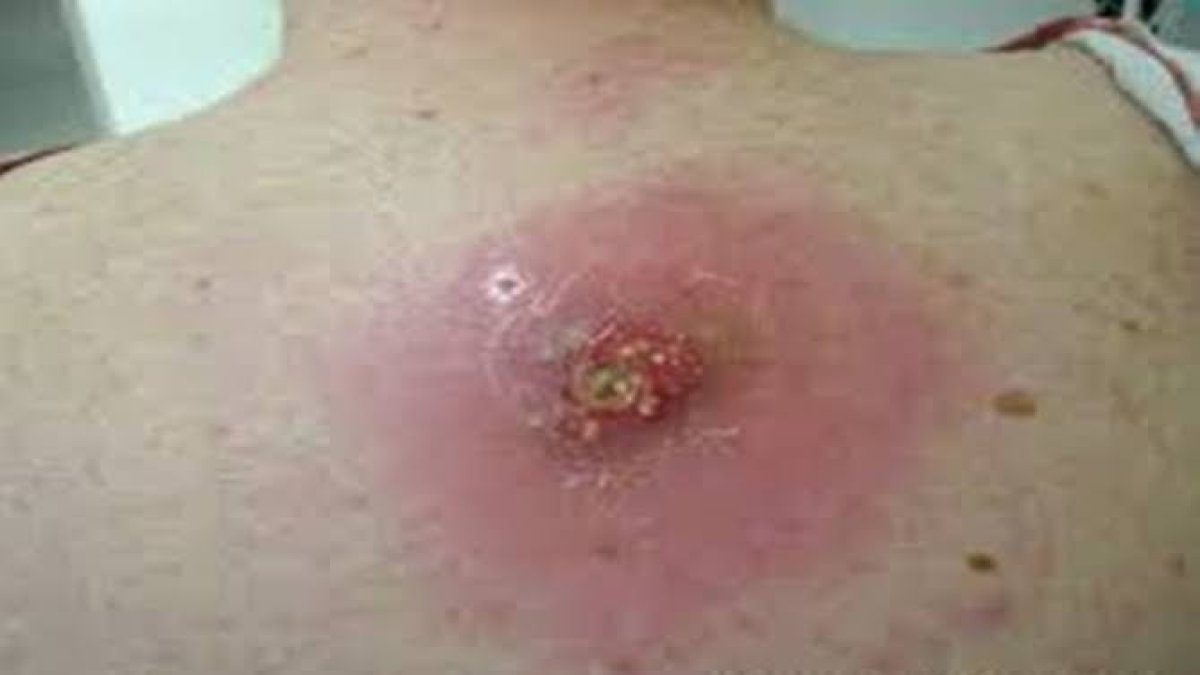 İltihaplı bölgesi saniyede kurutuyor! Suyunu sıkıp sürün