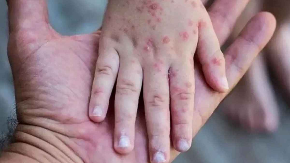 Uzmanından ölüm oranı yüzde beşe çıktı uyarısı: Maymun çiçeği hızla yayılıp öldürüyor