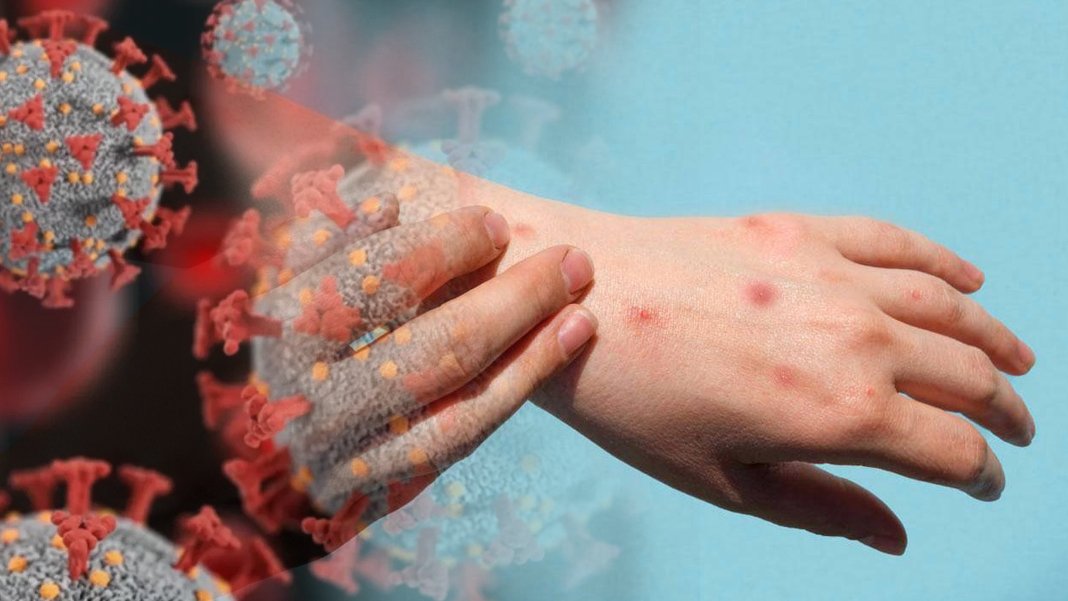 Sağlık Bakanlığı'ndan maymun çiçeği rehberi