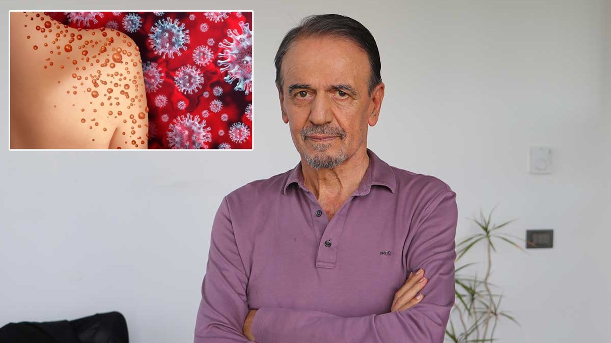 Prof. Dr. Mehmet Ceylan'dan maymun çiçeği uyarısı: Harekete geçmezsek geç olacak