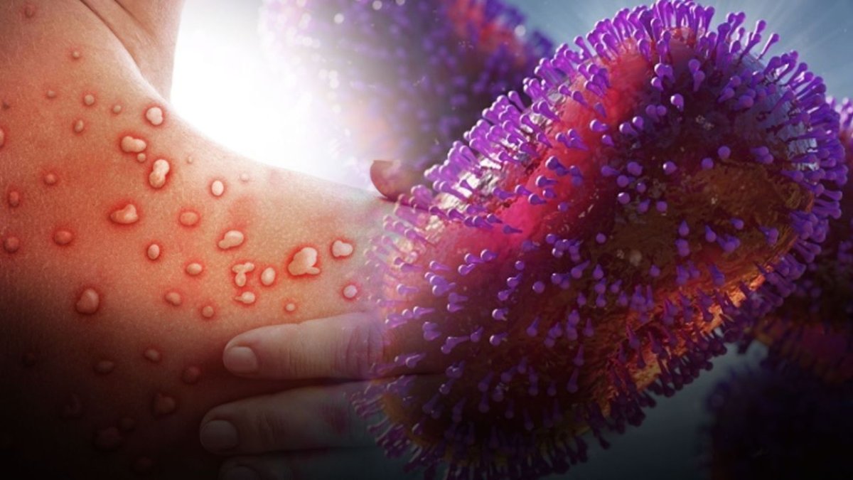 M çiçeği virüsü yayılıyor: Bir ülkeye daha sıçradı