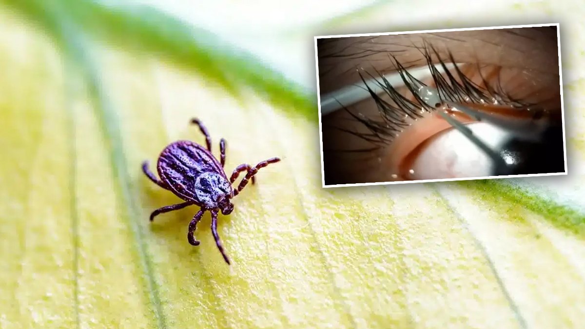 Bir etkisi daha ortaya çıktı: Kene ısırığı görme kaybına yol açabilir