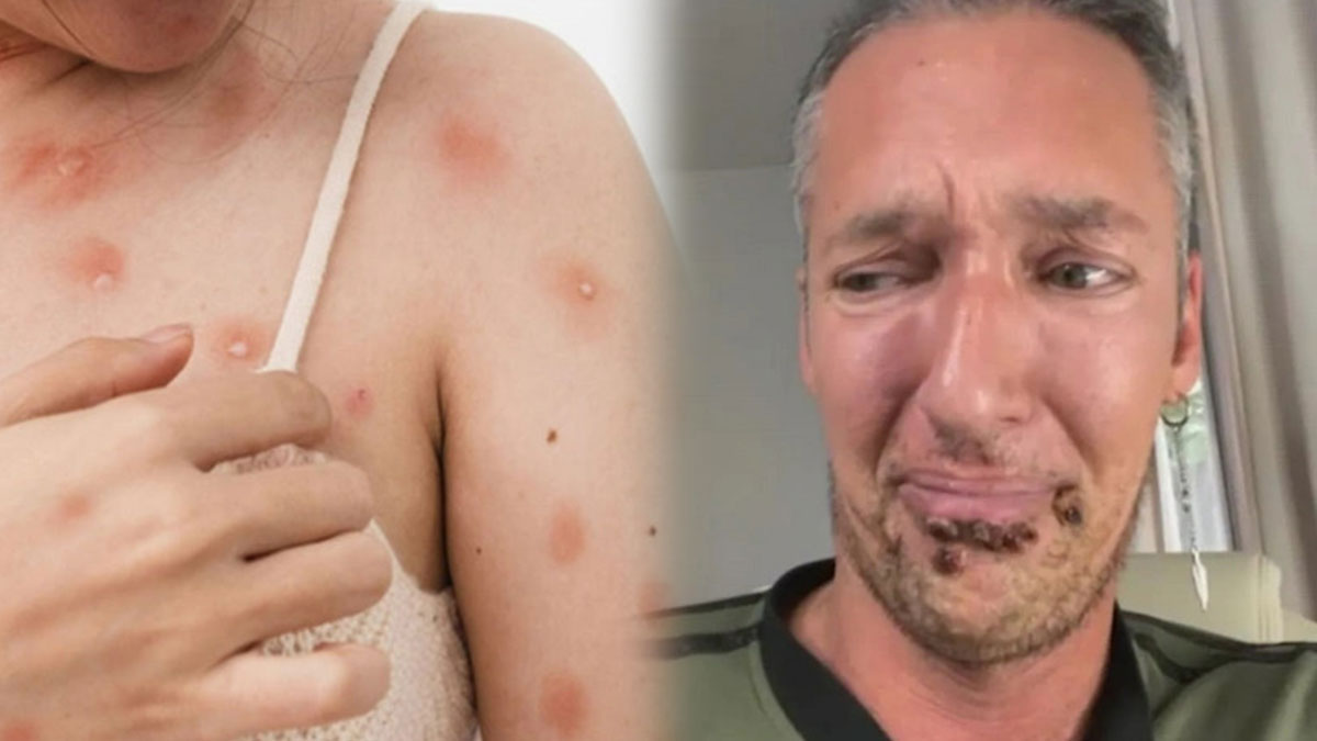 DSÖ doğruladı: Bu hastalık giysiden bile bulaşıyor! Dünya, yeni salgın hastalıkla karşı karşıya