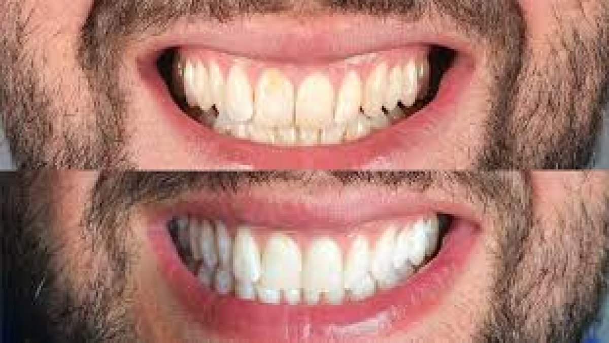 Sararmış dişi inci gibi yapıyor: Dişçiye gitmeye gerek kalmadı
