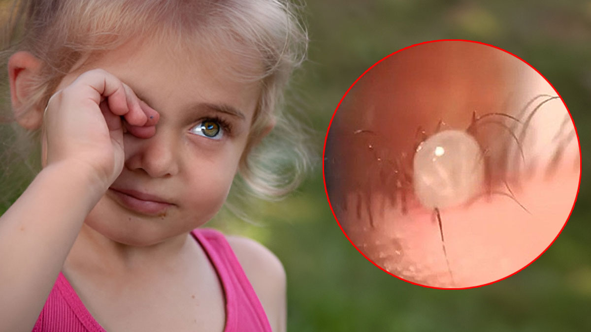 Kaşıntı şikayetiyle hastaneye gitti: Gözünden canlı canlı çıkarıldı! Doktorlar bile şaştı kaldı