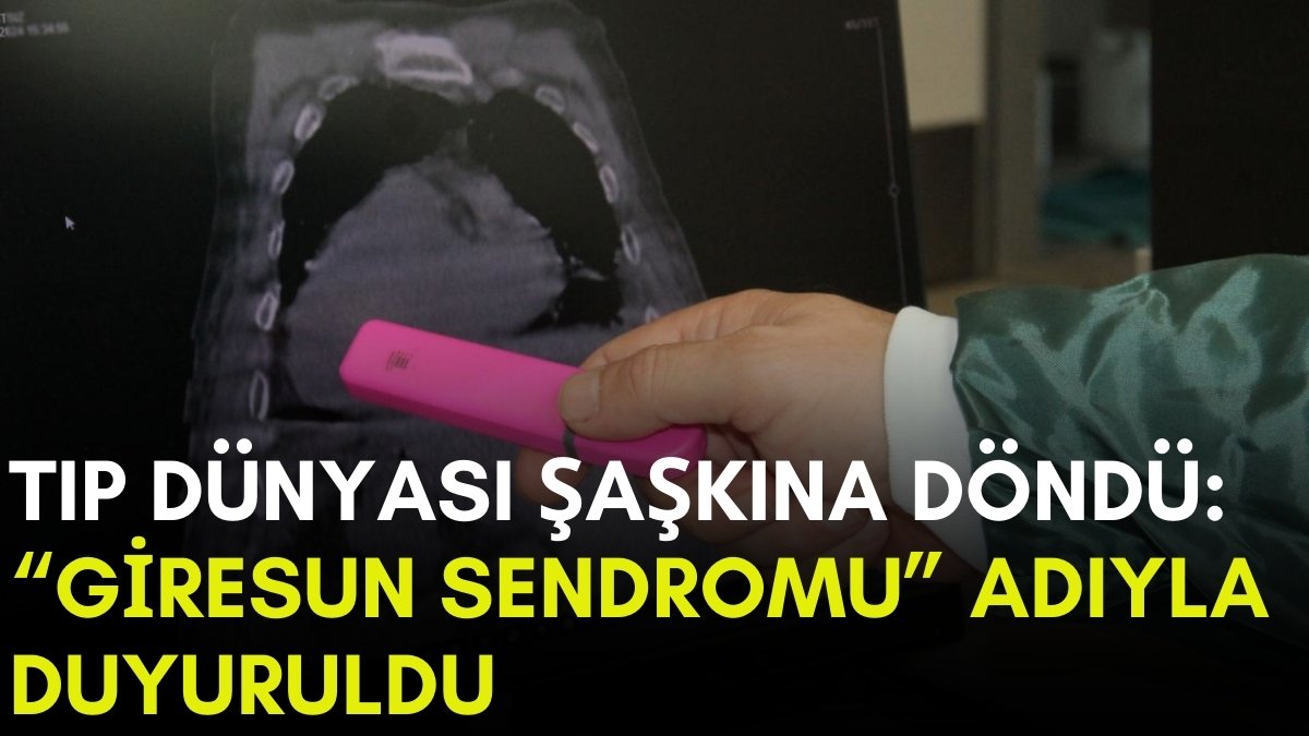 Dünyada bir ilk Giresun'da görüldü! Tıp dünyasını şaşkına çeviren hastalık: Giresun Sendromu adı verildi
