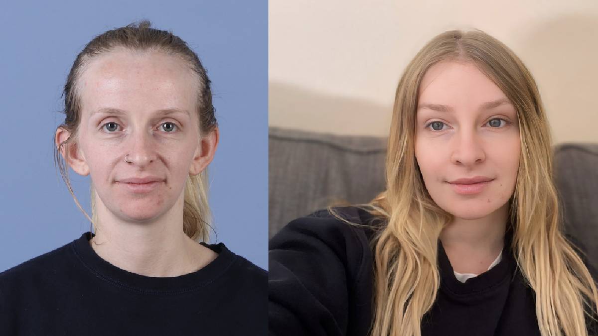 Dr. Cengizhan Ekizceli, alın daraltma ameliyatında 11 estetik işlemi daha gerçekleştirdi