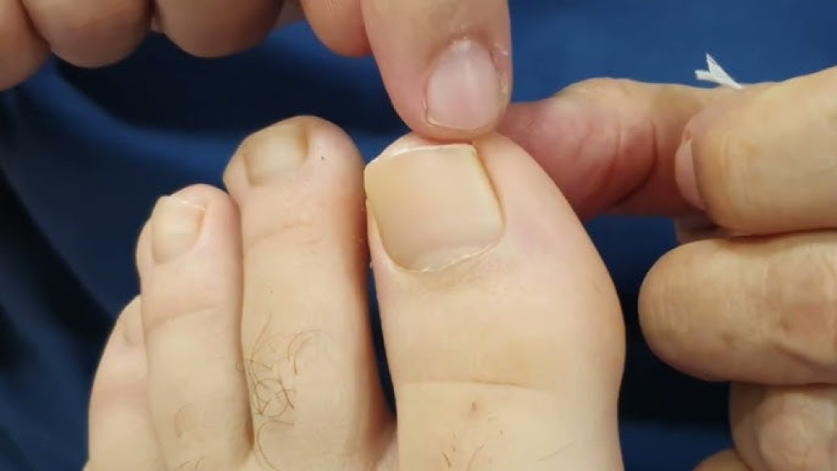 Tırnak batmasından ameliyatsız kurtulun: 1 hafta bu çayı sürün yeter