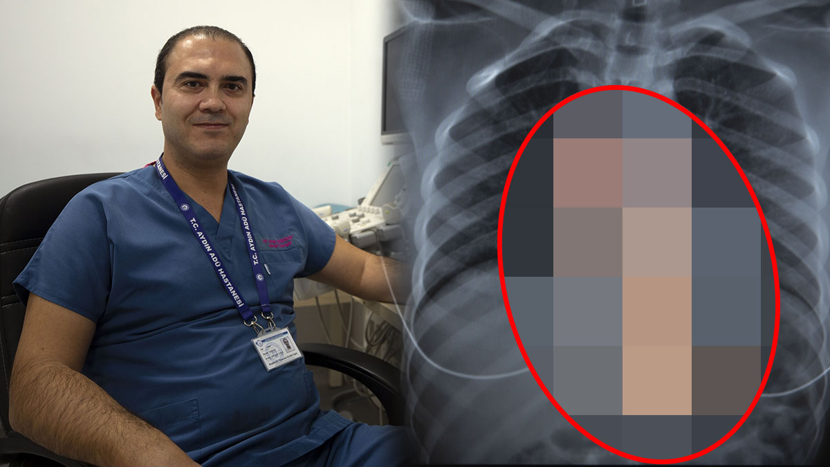 O cismi nasıl yuttun: 18 cm uzunluğunda! Doktorlar da şaştı kaldı, böyle vaka görülmedi