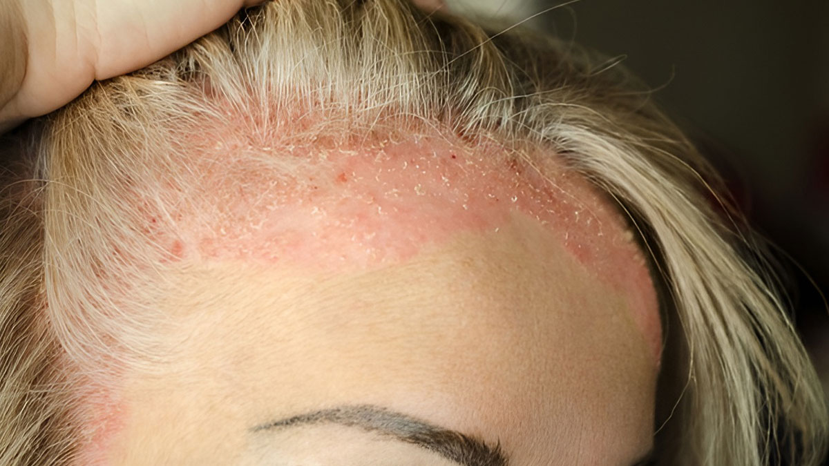 Doğru beslenmeyle egzamayla mücadele etmek meğer mümkünmüş! İşte egzamaya iyi gelen yiyecekler...