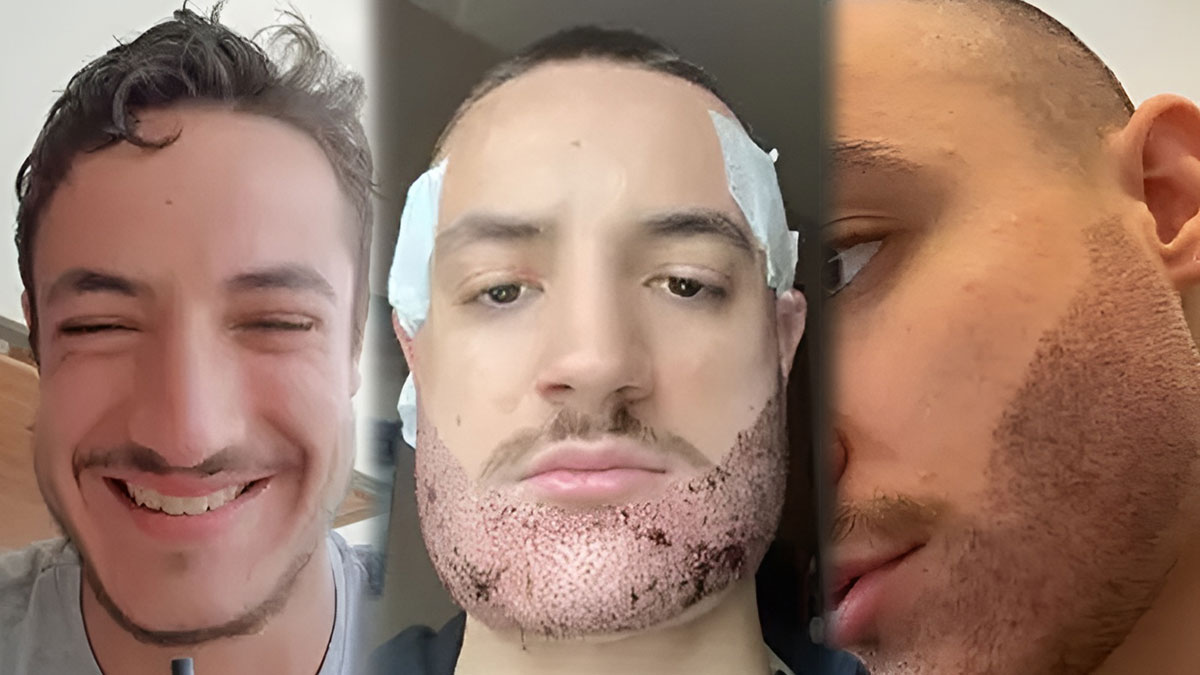 Sakal nakli yaptırdığı sözde uzmanın gerçek mesleği şoke etti! Yanlış ekim nedeniyle psikolojik bunalıma girip intihar etti