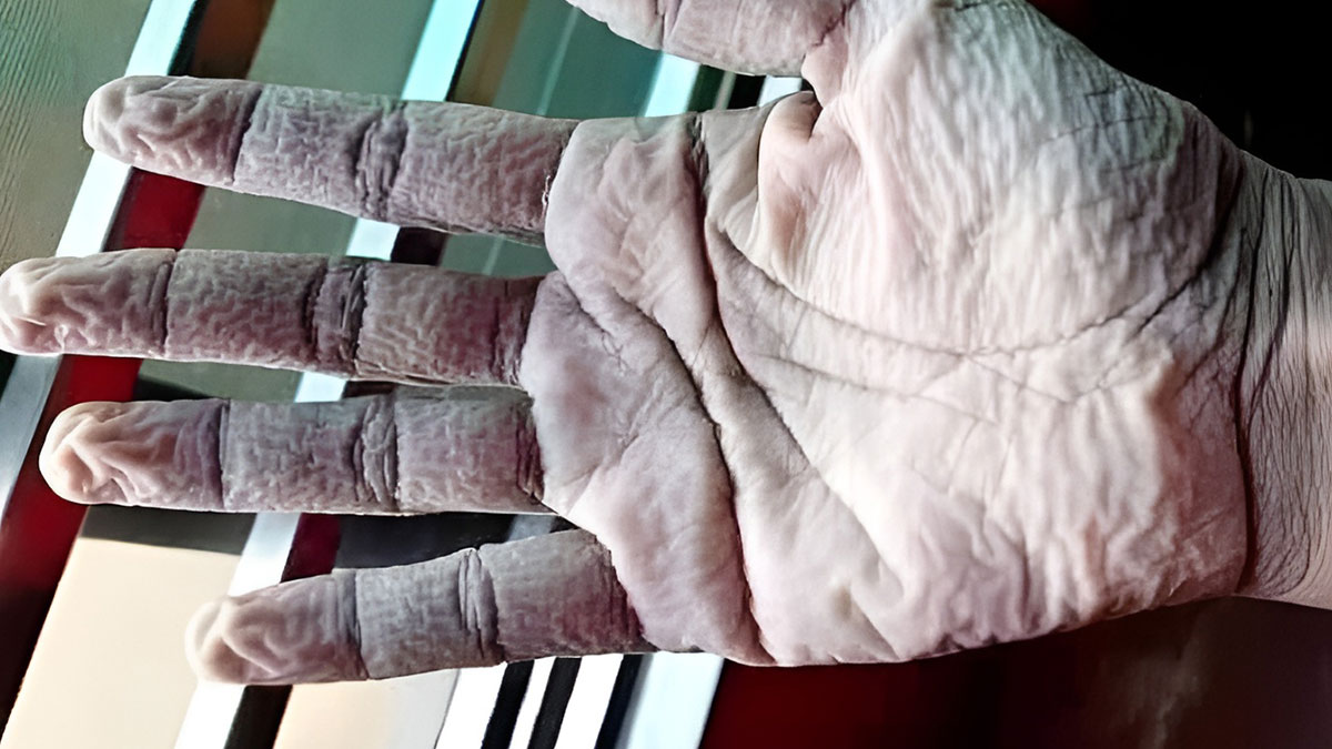 Suya temas eder etmez parmaklarınız buruşuyorsa eyvah! Hemen bu önlemleri alın