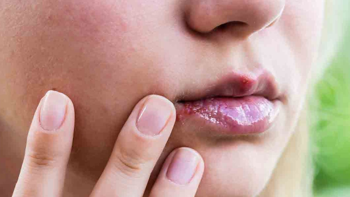 Uçuk deyip geçmeyin: Beyne bile sıçrayabilir! Bu belirtiler varsa sanıldığından daha riskli olabilir