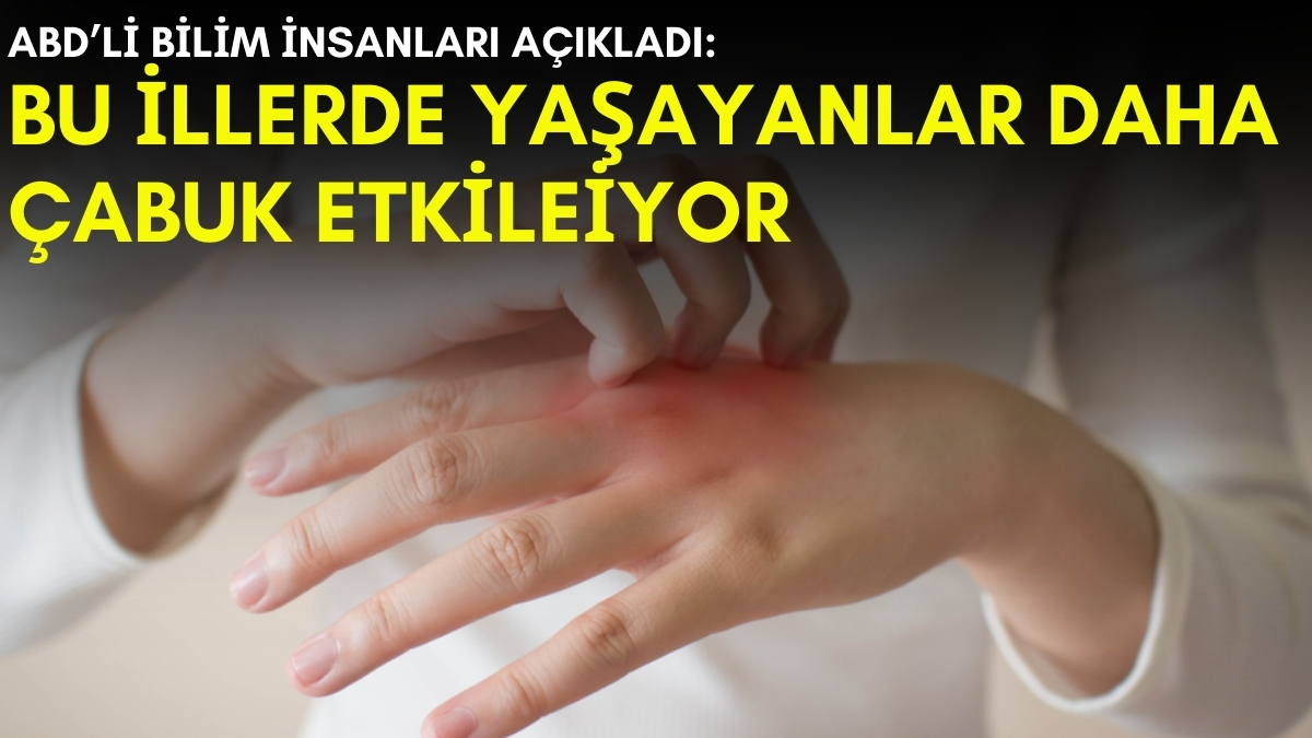 Bu illerde yaşayanlar daha fazla egzama oluyor! ABD'li bilim insanları araştırdı: Nedenini duyunca şok olacaksınız