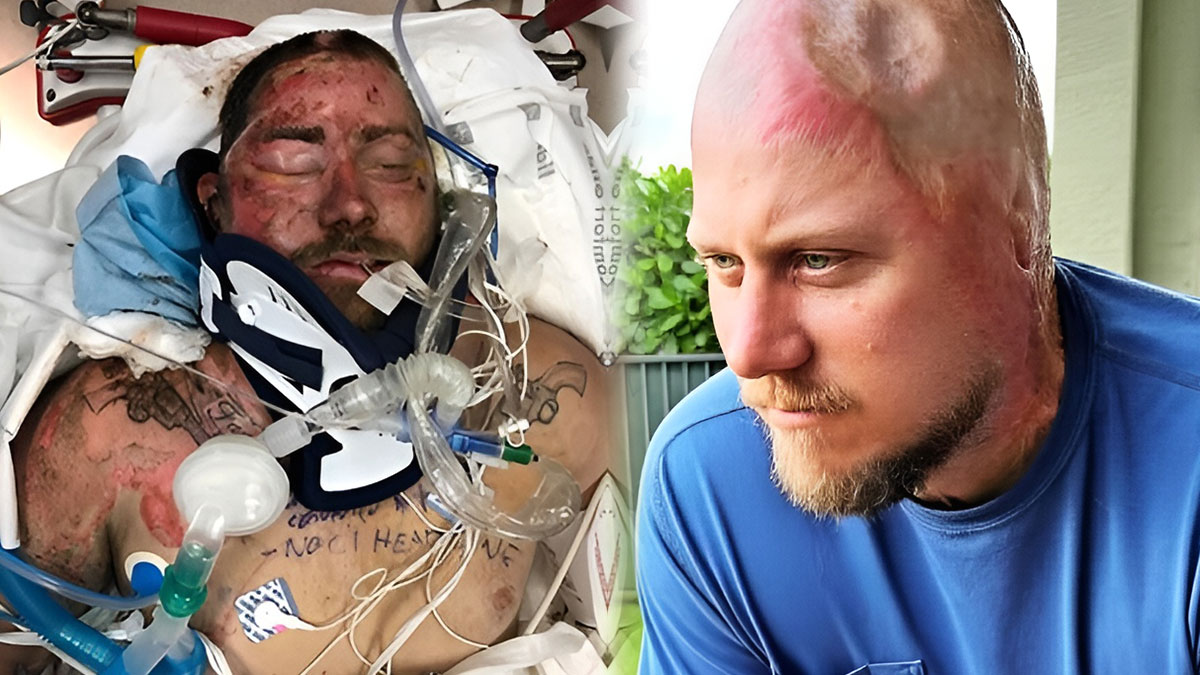 Yüksek gerilime kapıldı, kafasında delikle geziyor! Kafatasının yarısı eridi, 'Yaşama şansı yüzde 5' dendi