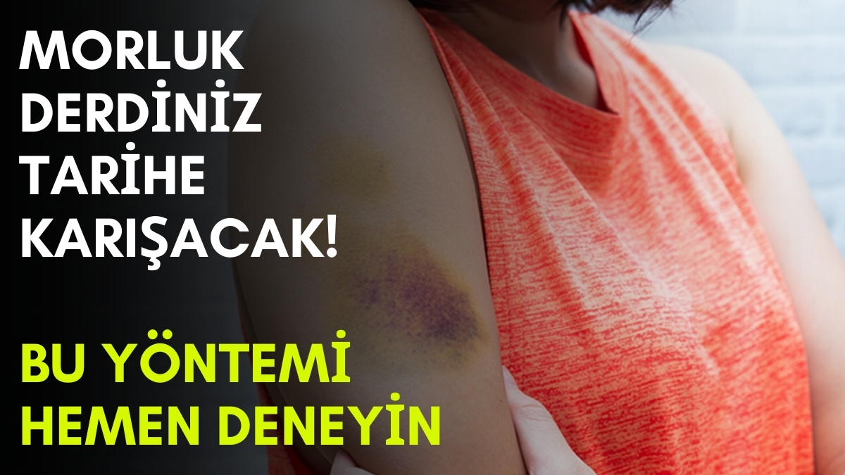 Vücutta oluşan morlukları geçiren en basit yöntem! Üzerine ince bir tabaka sürün, farka şok olacaksınız