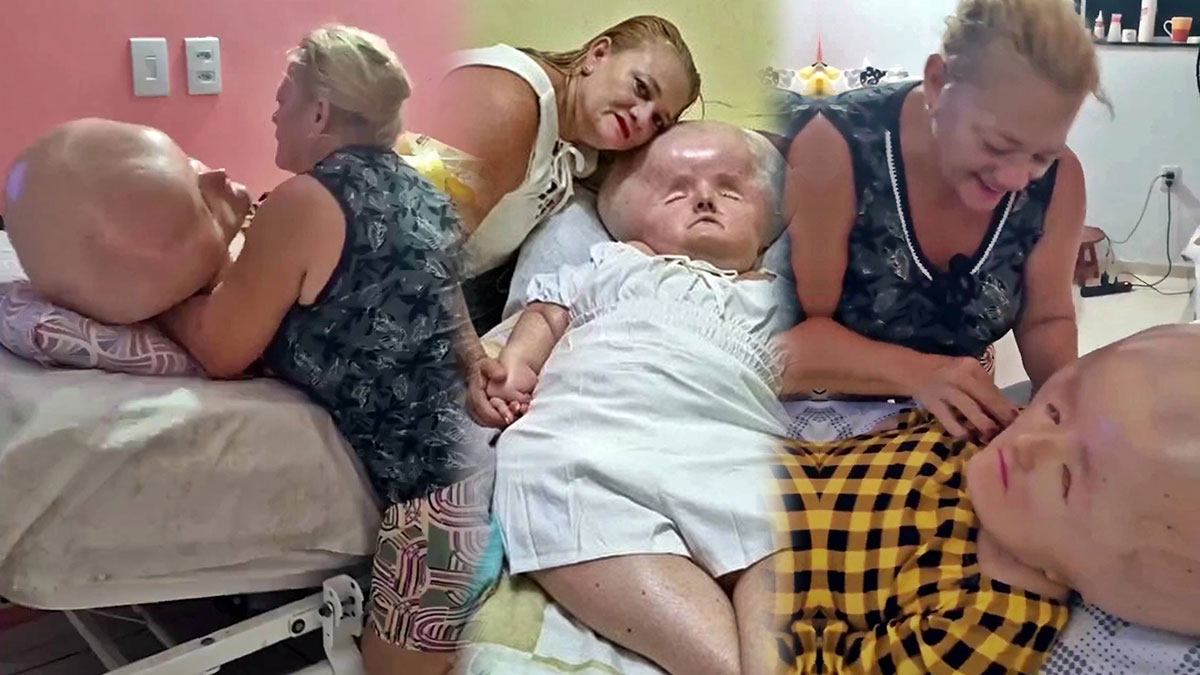 3 ay yaşamaz denilen kız 30 yaşına girdi: Annesi hayatını ona adadı! Dünyanın en nadir hastalığıyla mücadele ediyor