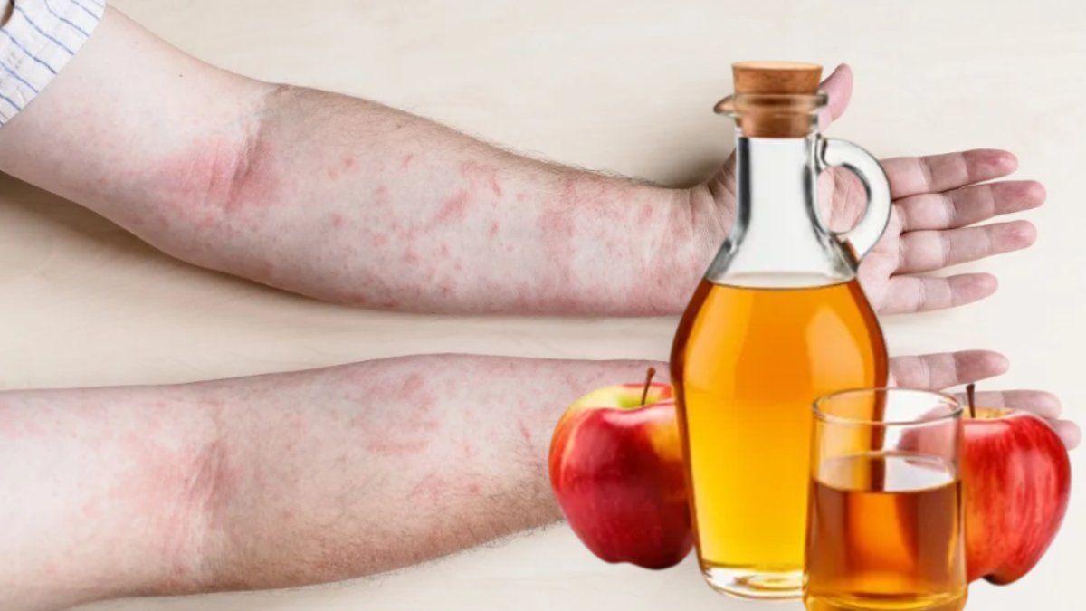 Egzama belasını bitiren dünyanın en kolay tarifi! Ünlü enfeksiyon bilimci sirke mucizesini yazdı herkes şifa buldu