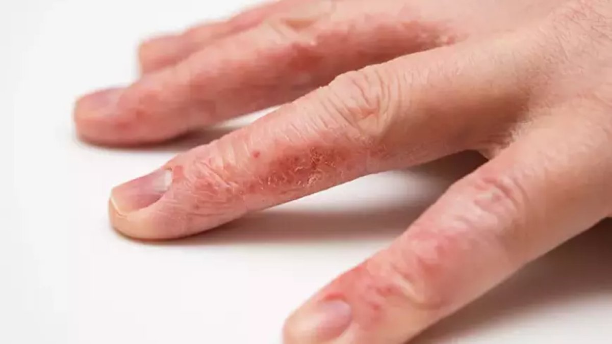 Sakın cildim yağlı deyip atlamayın! Kuru cildin en büyük sebebi: Zamanla kuruluğa neden oluyor