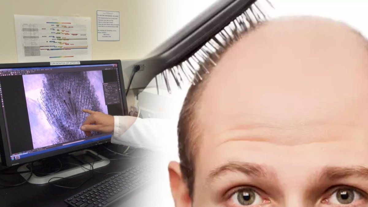 Saç Dökülmesine Elveda, Uzun ve Gür Saçlara Merhaba! Saçları geri çıkartmak bu kadar basitmiş