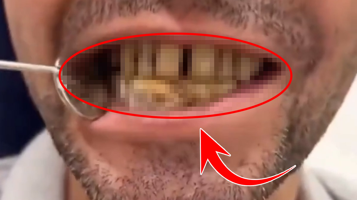 Japon yapıştırıcılı diş vahşeti: Sosyal medyada şoke eden görüntüler!