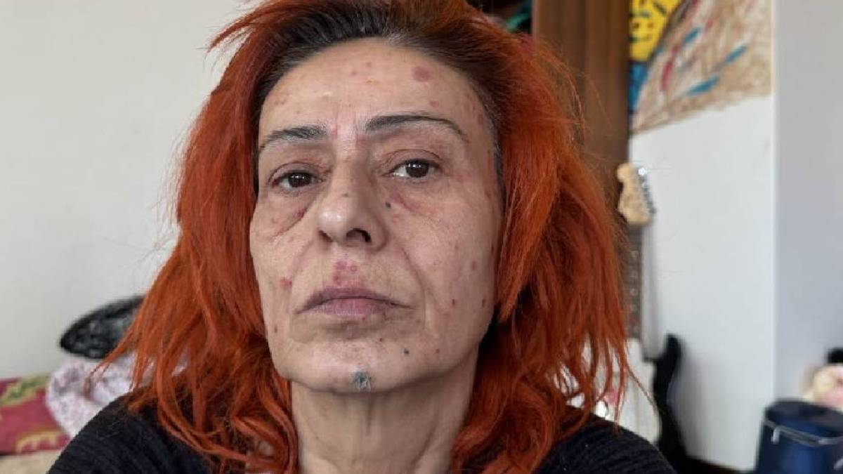 Yıldız Tilbe'nin yüzü yandı: ‘Bir daha saçıma boya sürmeyeceğim’