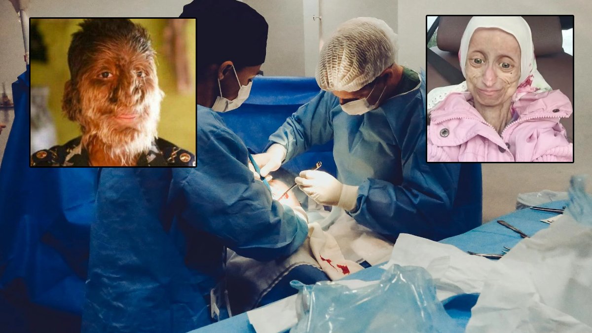 Erken Yaşlanma Sendromu’ndan Kurt Adam Sendromu’na… Dünyada milyonlarca insan bu hastalıklarla savaşıyor