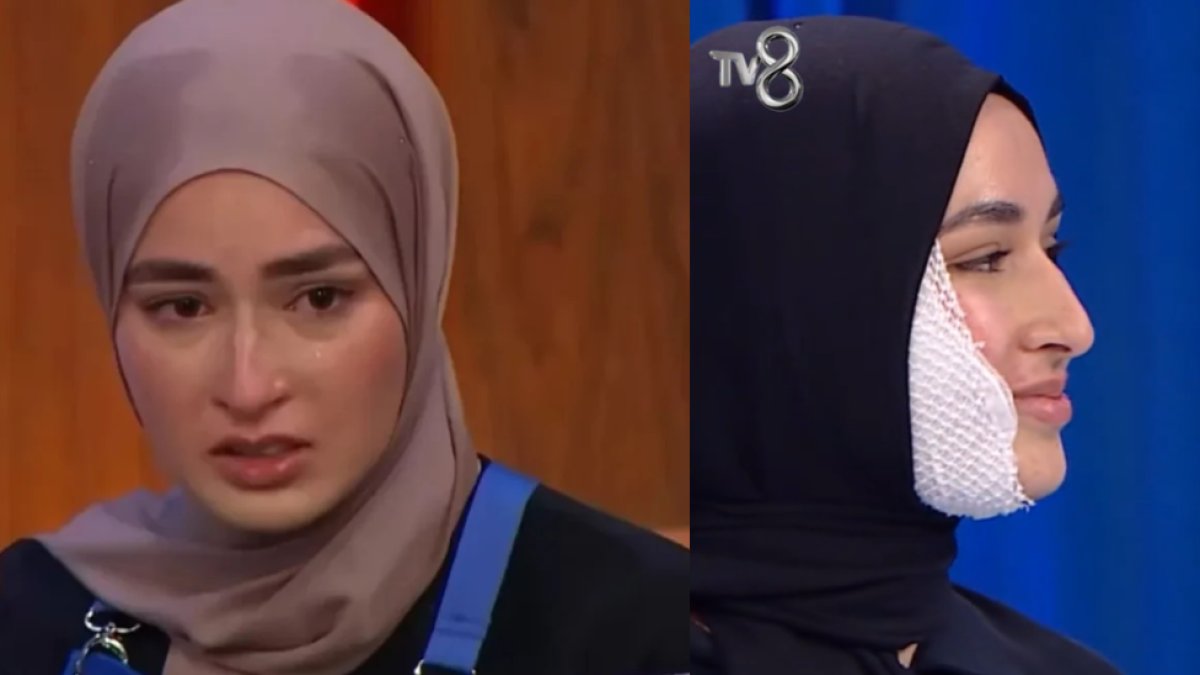 MasterChef yarışmasında yüzü yanmıştı! Aylar sonra ilk kez gösterdi: "Hassasiyetliyseniz bakmayın!"