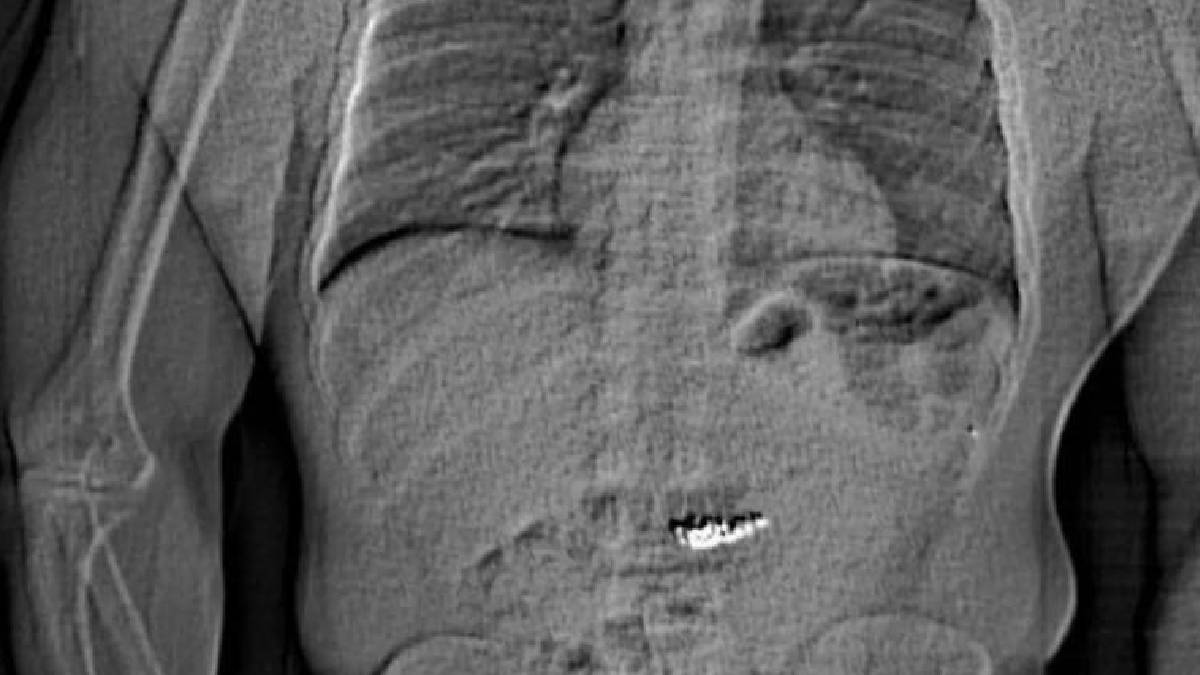 Polisten kaçan hırsız 769 bin dolarlık küpeleri yuttu