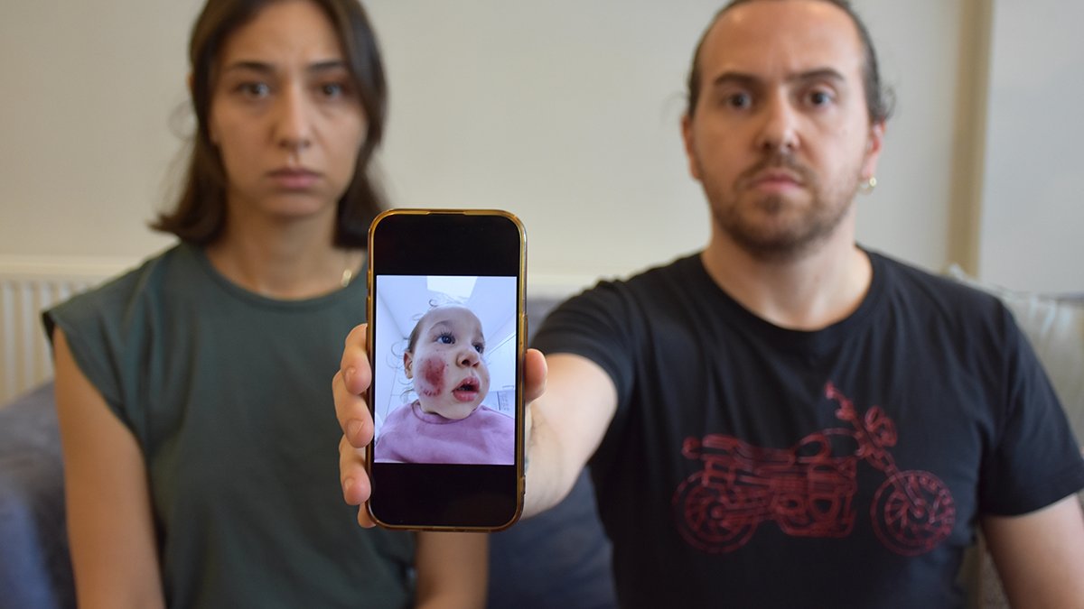 İki yaşındaki bebeğe kreşte akran zorbalığı: Yüzü parçalanmıştı, morluk içindeydi