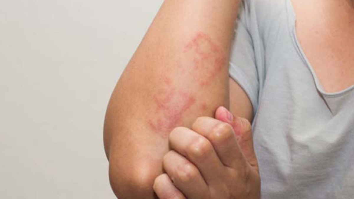 Cilt kanserinde melanom tehlikesi