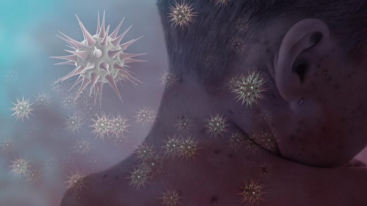 Unutulan tehlike geri döndü, vakalar arttı! Geçen yıldan 3 kat fazla: O ülkede kızamık alarmı verildi